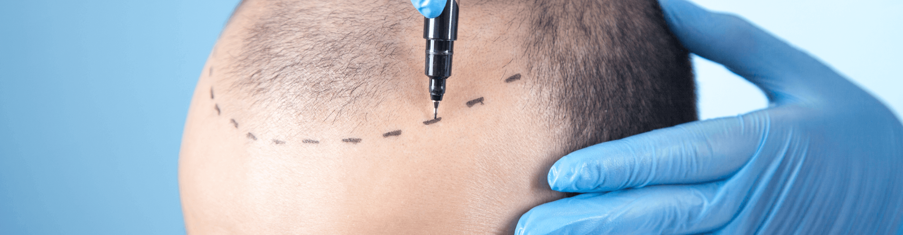 Hair Transplant In Bangalore